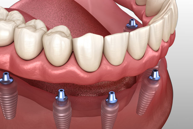 implant supported dentures model