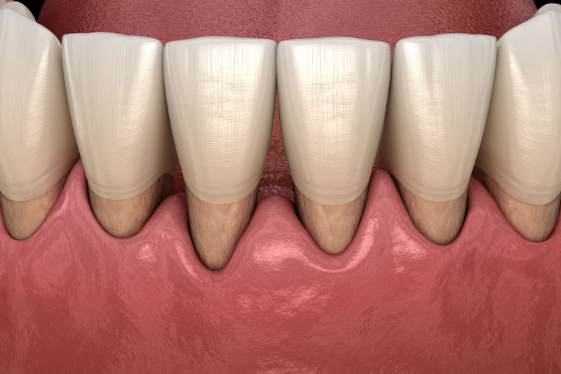 gum recession graphic