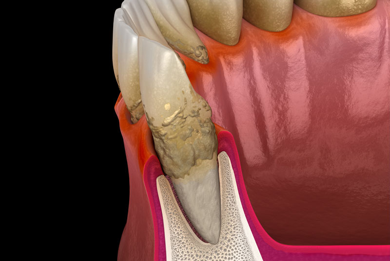 gum recession model showing bacertia growth