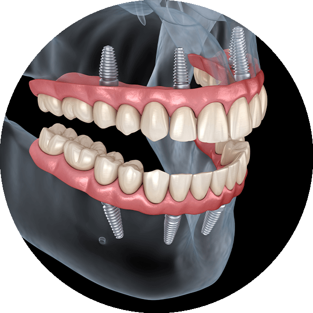 all-on-4 dental implants