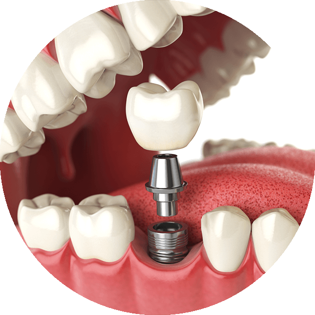 single dental implant