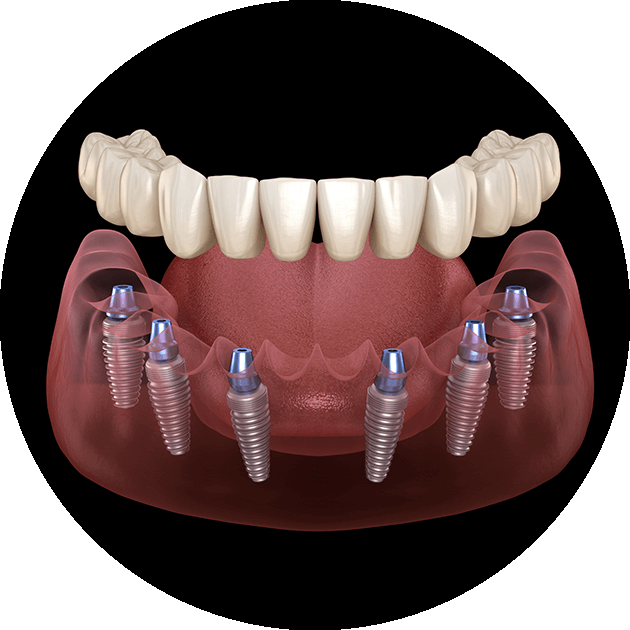 snap-on dental implants